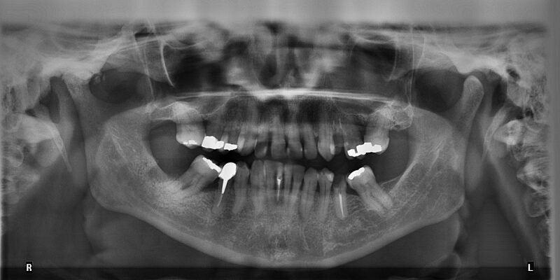 How to prevent dental diseases (1)