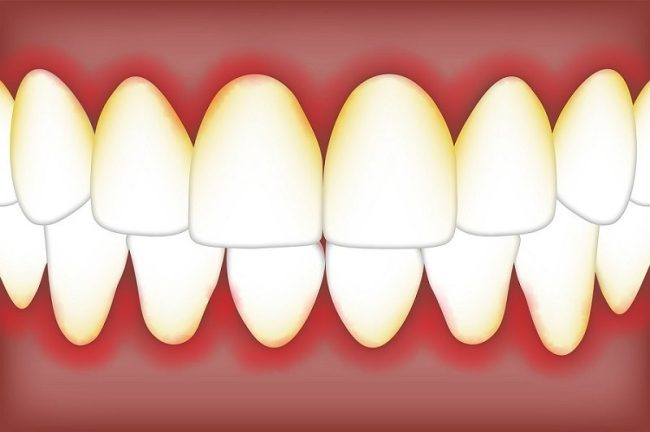 Causes and Treatments for Periodontitis