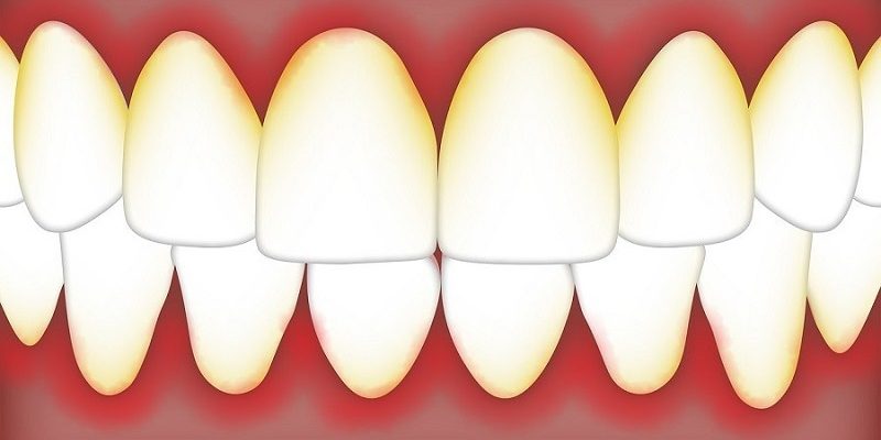 Causes and Treatments for Periodontitis
